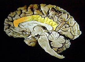 Le cortex cingulaire (en jaune) et sa partie antérieure (en orange) sur une coupe sagittale du cerveau